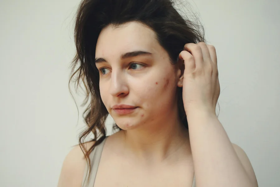 How to Cover a Pimple With Makeup