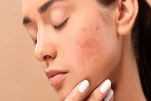 How To Reduce Pimple Redness in 5 Minutes Fast