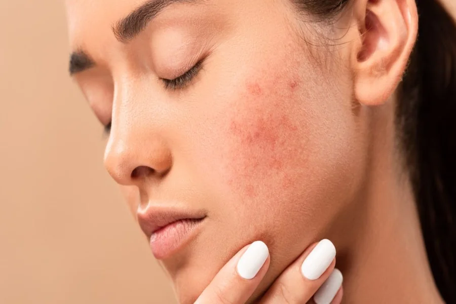 How To Reduce Pimple Redness in 5 Minutes Fast