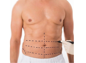 Liposuction in Riyadh with Advanced Techniques and Natural Results