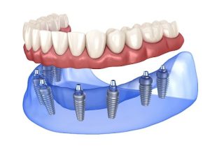 The Celebrity Dental Procedure That’s Gone Completely Mainstream