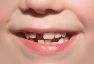Wh‌y Dental Imp​la‌nt Newcast‌le Is the Best Choice for Missing Teeth