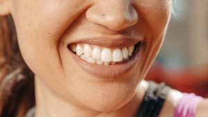 From Hollywood Caps to Modern Veneers: A Smile History